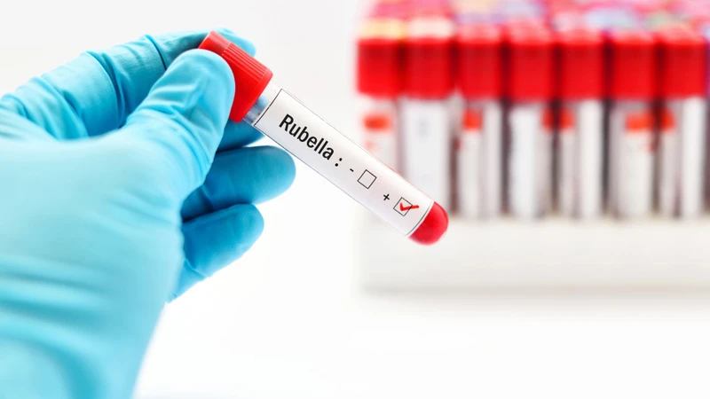 Dấu hiệu bệnh Rubella ở bà bầu và những thông tin cần biết 4