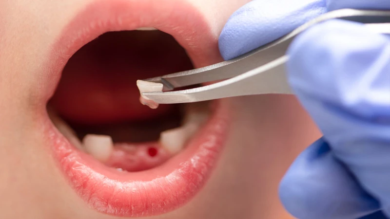 Cách nhổ răng sữa cho trẻ tại nhà an toàn 4