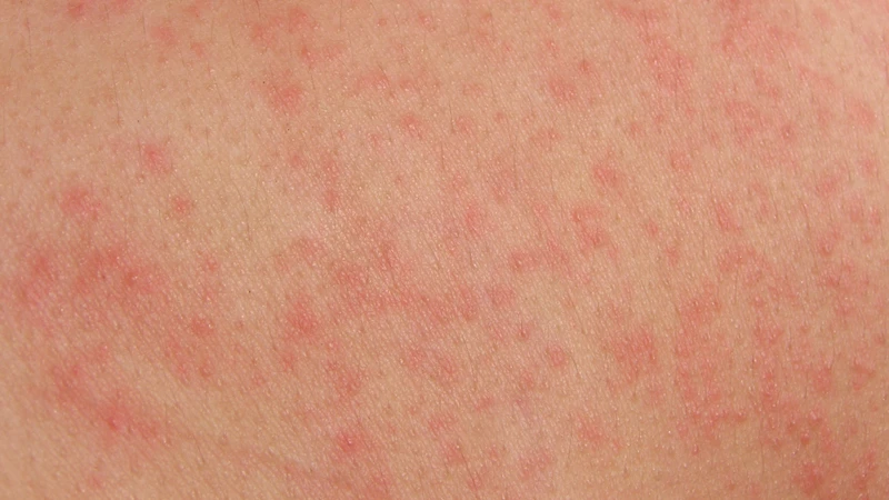 Các biểu hiện trên da ở người bị sốt xuất huyết chủ yếu là phát ban hoặc xuất huyết dưới da do giảm tiểu cầu và tăng tính thấm thành mạc