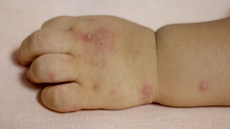 Trẻ vẫn có thể mắc tay chân miệng nhiều lần do các chủng virus khác nhau