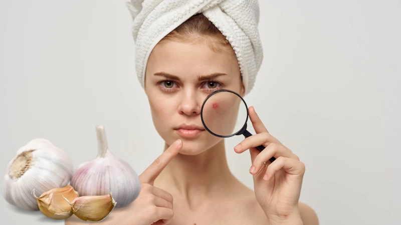 Cách trị mụn nhọt bằng tỏi: Hiểu đúng để sử dụng hiệu quả và an toàn 1