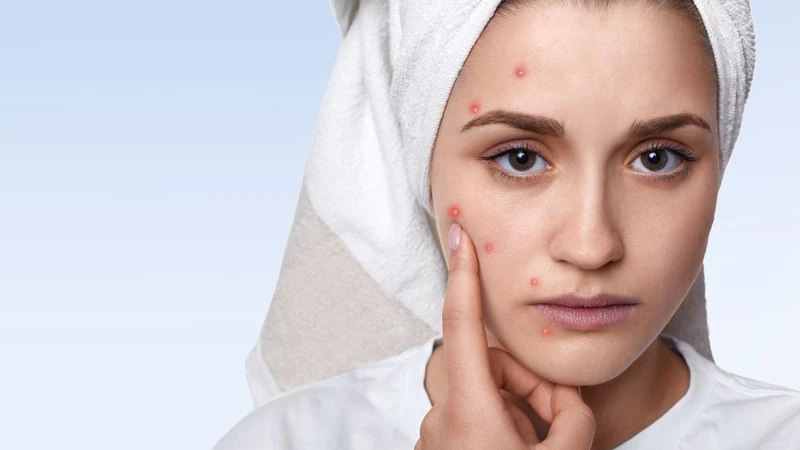 Cách trị mụn nội tiết​ hiệu quả và an toàn 1