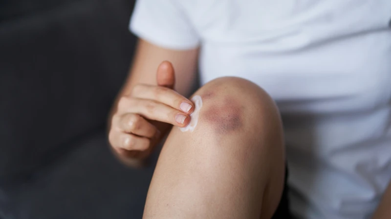 Cách trị vết bầm tím nhanh nhất và hiệu quả bạn có thể tham khảo 2