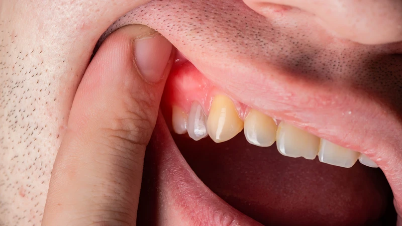 Cao răng huyết thanh không được xử lý kịp thời có thể dẫn đến nhiều biến chứng răng miệng