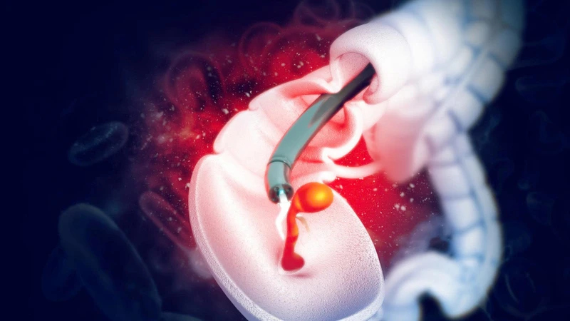 Cắt polyp đại tràng có phải kiêng quan hệ không? Câu trả lời là có vì cơ thể cần thời gian hồi phục
