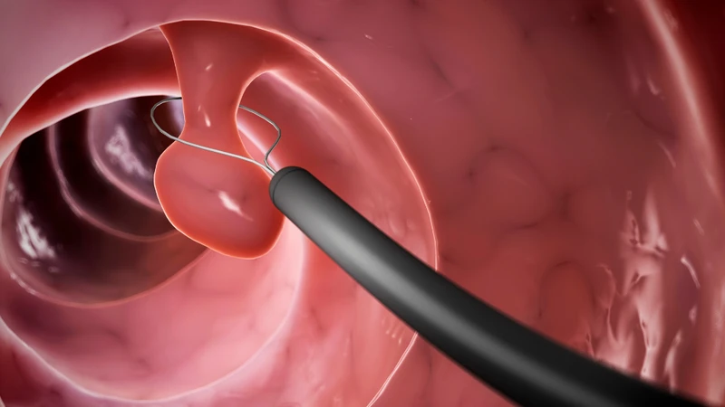 Cắt polyp mũi có đau không? Những điều cần biết trước khi quyết định phẫu thuật 1