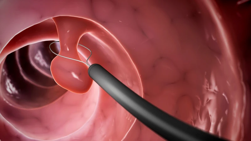 Cắt polyp mũi: Khi nào cần, quy trình và lưu ý quan trọng 1