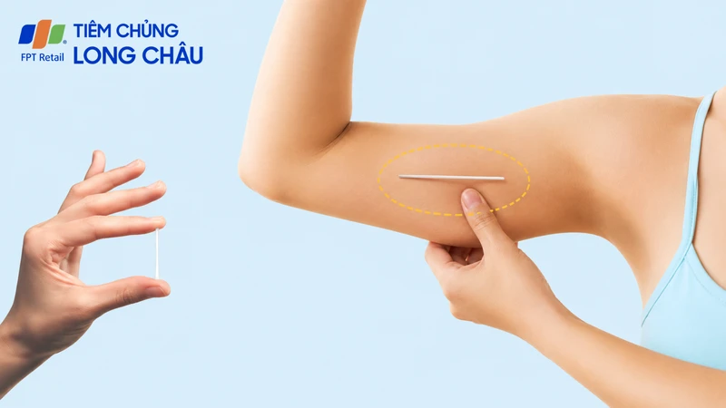 Cấy que tránh thai có được xuất vào trong không là thắc mắc thường gặp