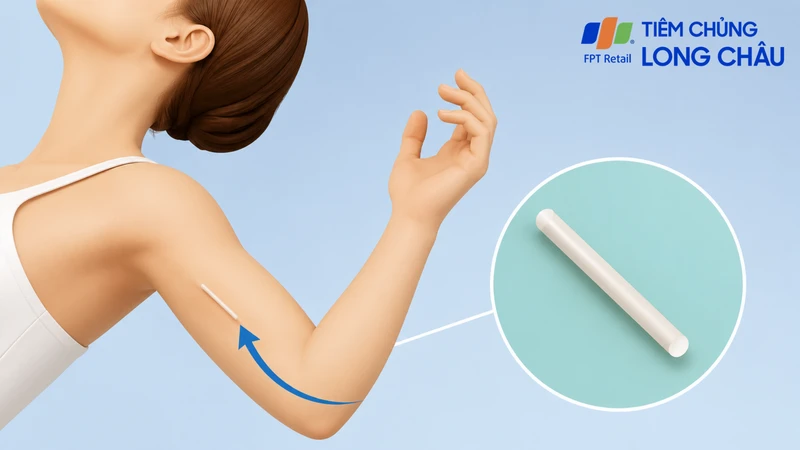 Hormone từ que tránh thai giúp ngăn quá trình thụ thai
