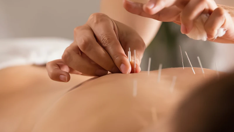 Nên lựa chọn châm cứu tại cơ sở y tế và người thực hiện có chuyên môn