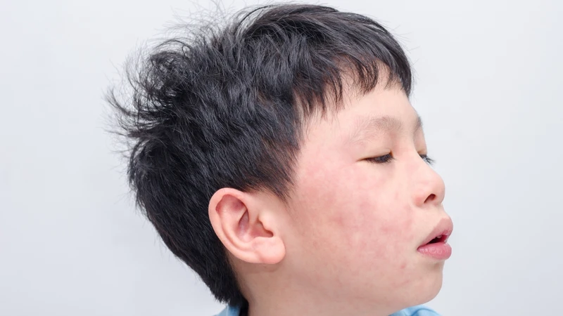 Chăm sóc trẻ phát ban sau sốt là quan tâm của nhiều phụ huynh khi hiện tượng nổi ban xuất hiện lúc cơn sốt đã lui dần