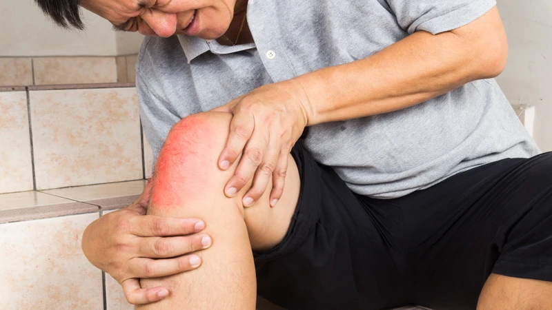 Sau chấn thương, khớp gối thường sưng nhanh chóng chỉ trong vòng vài giờ
