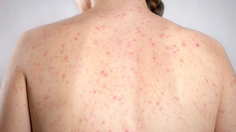 Thời gian phục hồi của chạy hậu thuỷ đậu tuỳ thuộc vào mỗi người