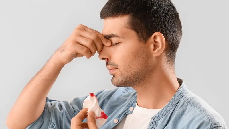 Chảy máu cam mùa nóng: Những điều bạn cần biết để phòng tránh hiệu quả 2