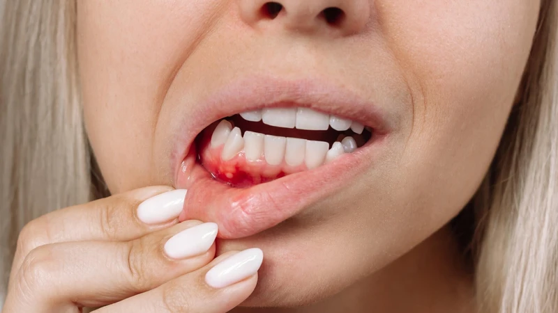 Chảy máu chân răng ung thư đi kèm các triệu chứng nổi hạch, mệt mỏi