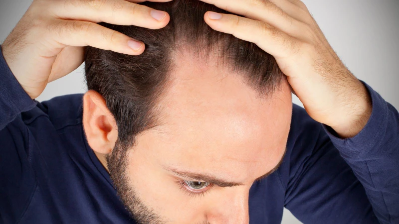 Khám rụng tóc là quá trình kiểm tra chuyên khoa nhằm xác định nguyên nhân gây rụng tóc