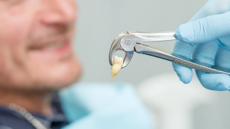 Chi phí nhổ răng khôn có bảo hiểm y tế không giống nhau ở tất cả các trường hợp