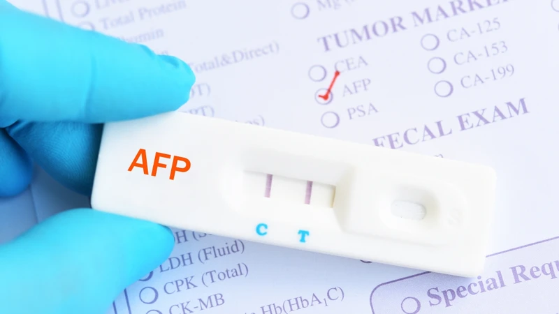 Chỉ số AFP trong máu bao nhiêu là bình thường​? Ở người trưởng thành khỏe mạnh, chỉ số AFP bình thường thường dưới 10 ng/mL