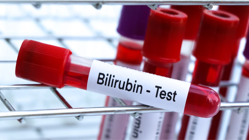 Chỉ số bilirubin bao nhiêu là nguy hiểm​? 3