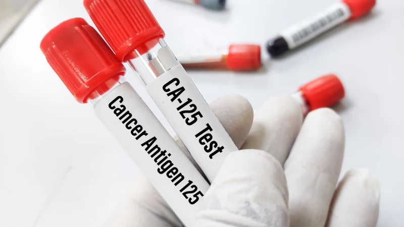 Chỉ số CA 125 là một loại protein được xem là chất chỉ điểm ung thư, thường được sử dụng để hỗ trợ chẩn đoán ung thư buồng trứng