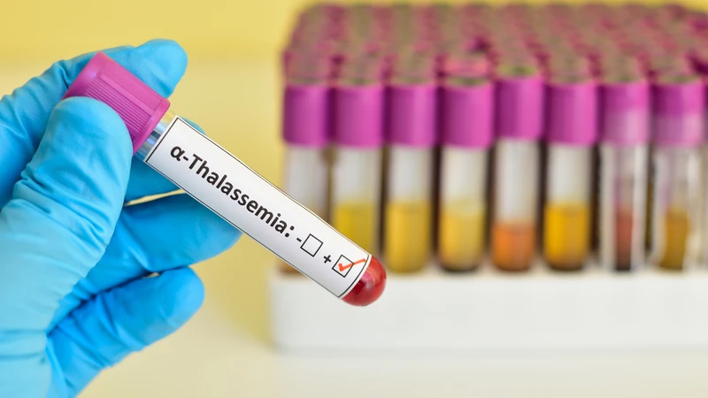 Phần lớn trẻ có Hb Bart's cao đều được thừa hưởng gen alpha-thalassemia từ cha mẹ