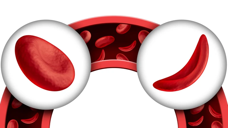Bệnh hồng cầu hình liềm là một dạng rối loạn hemoglobin do đột biến gen tạo ra hemoglobin bất thường (HbS)