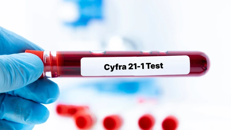 Chỉ số xét nghiệm Cyfra 21-1 là nồng độ của một phân đoạn cytokeratin 19 (CK19) hòa tan trong huyết thanh