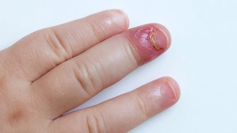 Chín mé ngón tay thường gây sưng đỏ, tích mủ, hình thành áp xe sau những tổn thương nhỏ
