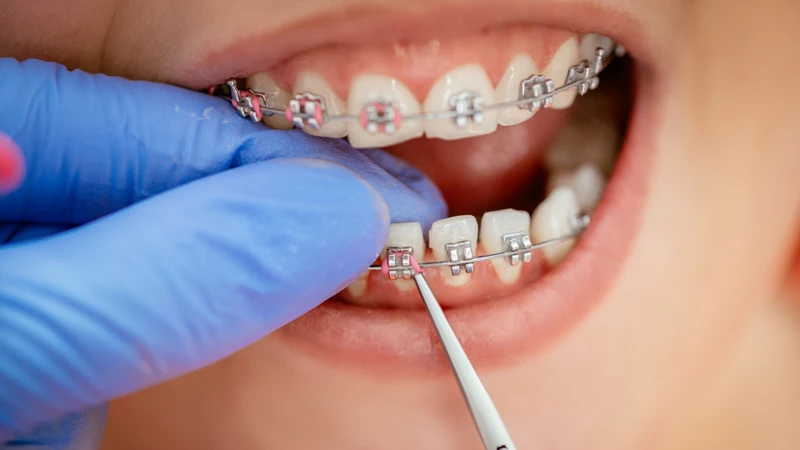 Thực hiện chỉnh nha trong trường hợp răng thưa giúp kéo gần khoảng cách giữa các răng