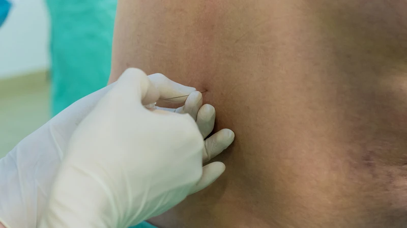 Chọc dò tủy sống là gì và khi nào cần thực hiện 1
