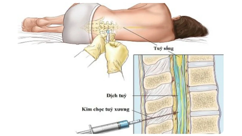 Chọc tủy xét nghiệm viêm màng não có ý nghĩa gì?  2