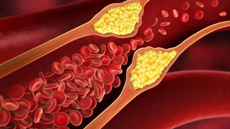Cholesterol cao là bệnh gì? Là tình trạng chất béo tích tụ quá mức trong máu làm tăng rủi ro tim mạch