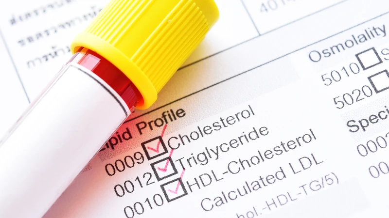 Xét nghiệm mỡ máu giúp xác định nồng độ cholesterol và triglyceride