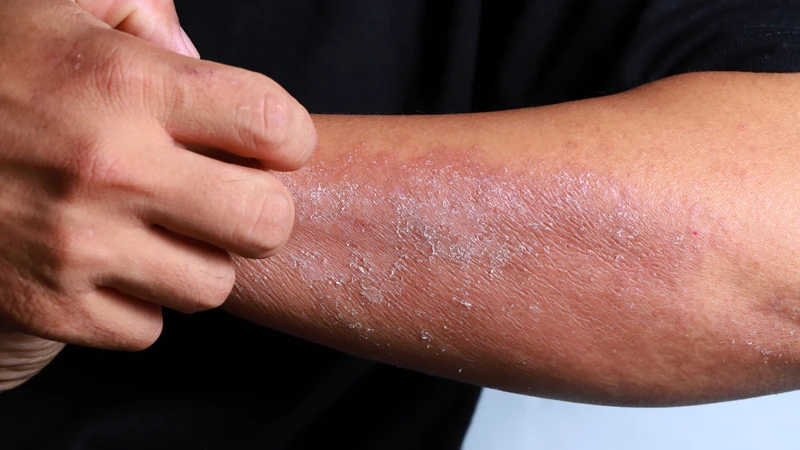 Tiếp xúc lâu với nước lũ chứa nhiều vi khuẩn và nấm dễ gây tổn thương da