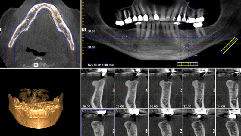 Chụp CT Cone Beam trong nha khoa có ưu điểm nổi bật là cung cấp hình ảnh 3D chi tiết