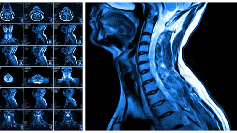 Chụp CT cột sống giúp phát hiện chấn thương: Gãy, nứt hoặc tổn thương xương cột sống