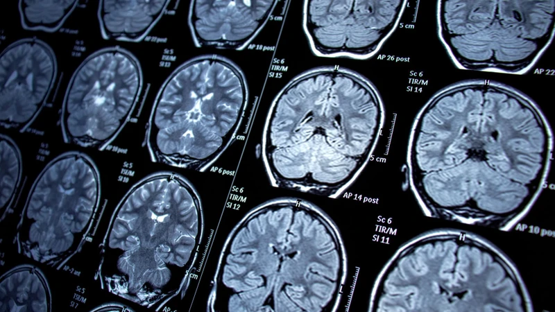 Chụp MRI là sử dụng từ trường mạnh và sóng radio để tạo hình ảnh chi tiết