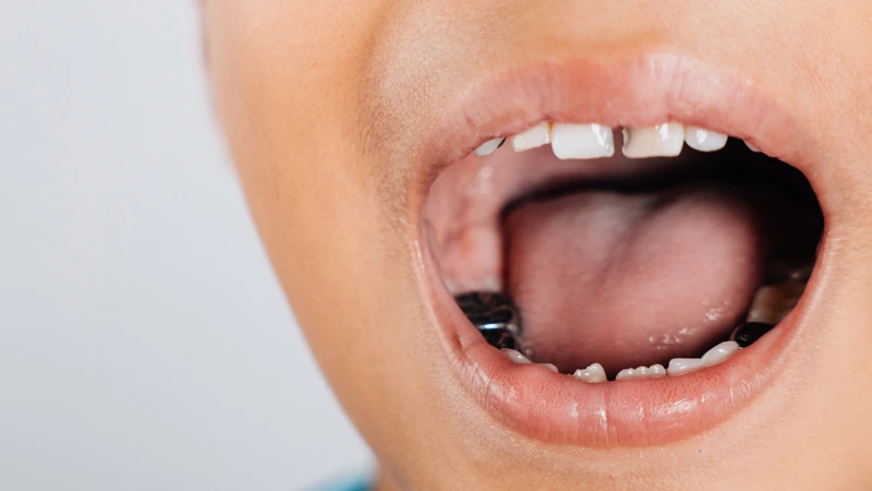 Chụp thép răng sữa giúp bảo vệ răng và duy trì chức năng đến khi thay răng tự nhiên