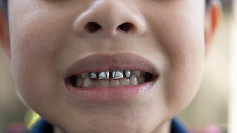 Mão thép không gỉ là giải pháp phục hình phổ biến cho răng sữa sau khi điều trị tủy