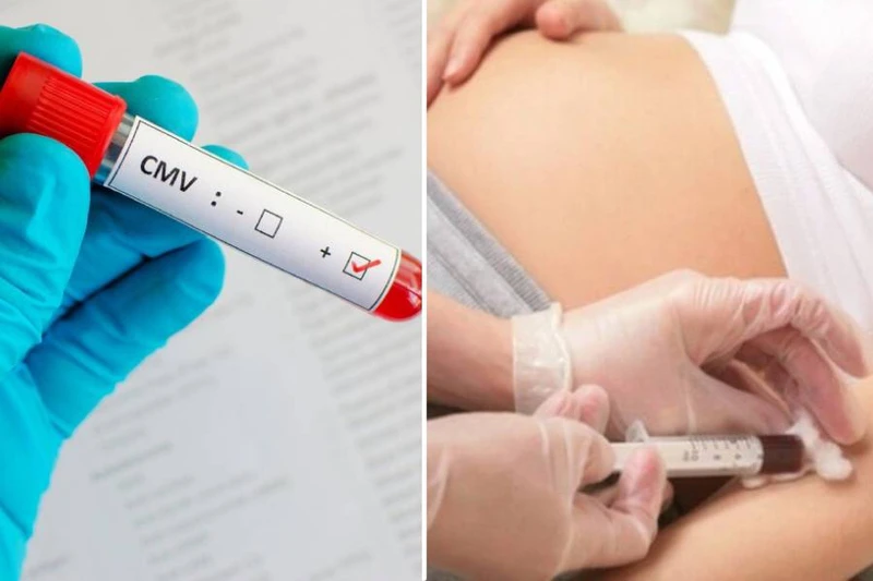 CMV IgG dương tính bà bầu có nguy hiểm không? Cách phòng ngừa nhiễm CMV trong thai kỳ 2