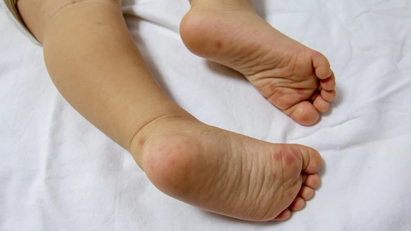 Tay chân miệng là bệnh truyền nhiễm do virus Enterovirus gây ra ở trẻ nhỏ