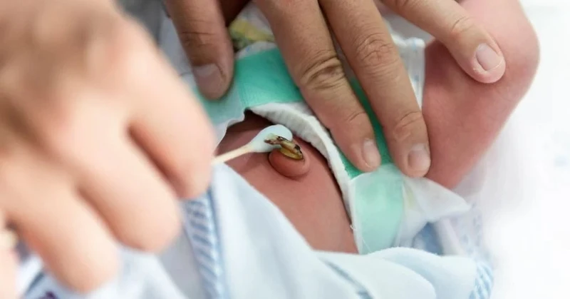 Ba mẹ nên vệ sinh rốn bằng nước muối và để thông thoáng giúp hạn chế tình trạng nhiễm trùng rốn