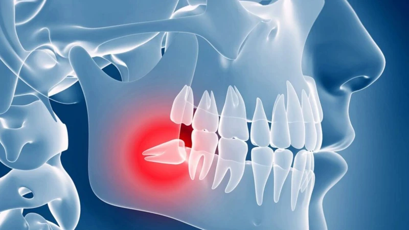 Răng khôn gây đau hoặc viêm lặp lại thường được bác sĩ khuyến nghị nhổ để xử lý triệt để và hạn chế tái phát