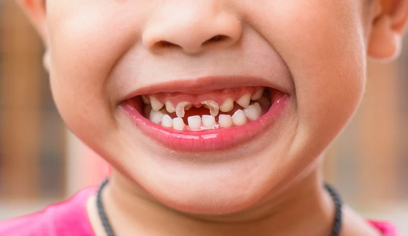 Phụ huynh thường băn khoăn liệu có nên nhổ răng sữa bị sâu hay không để tránh ảnh hưởng đến răng vĩnh viễn