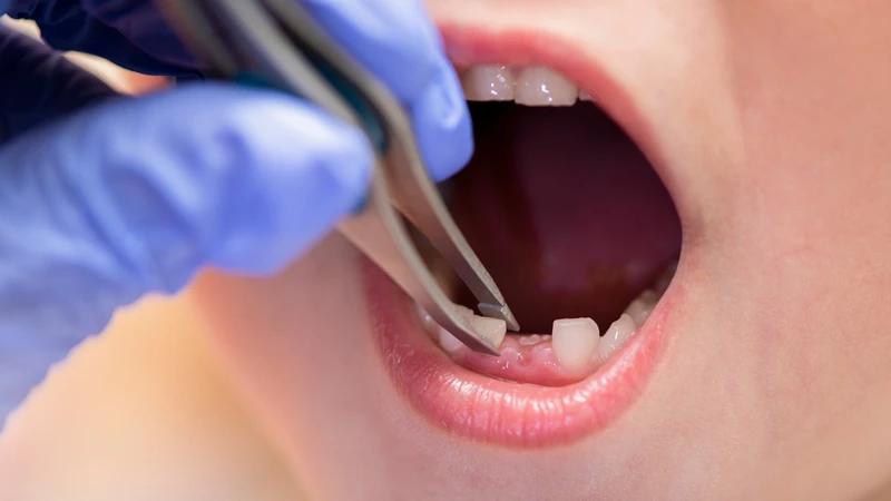 Có nên nhổ răng sữa khi chưa lung lay không? Không nên tự ý can thiệp hay nhổ răng sữa khi chúng chưa lung lay