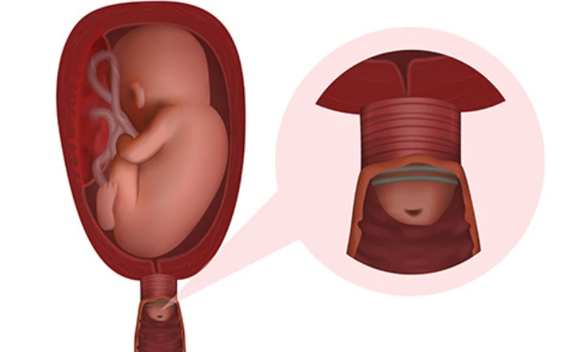 Sử dụng vòng nâng giúp giảm áp lực của thai thi lên cổ tử cung, từ đó ngăn chặn xóa mở sớm