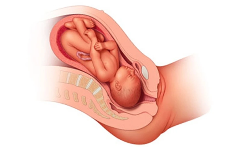 Nếu cổ tử cung hở ngoài trước 37 tuần cần cảnh giác nguy cơ hở eo cổ tử cung và sinh non