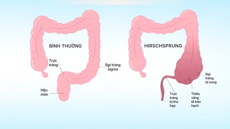 Bệnh Hirschsprung xảy ra khi một đoạn ruột thiếu các tế bào hạch thần kinh