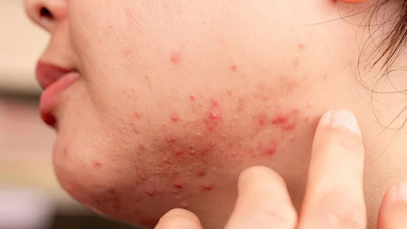 Cutibacterium acnes có vai trò quan trọng trong cơ chế hình thành mụn trứng cá