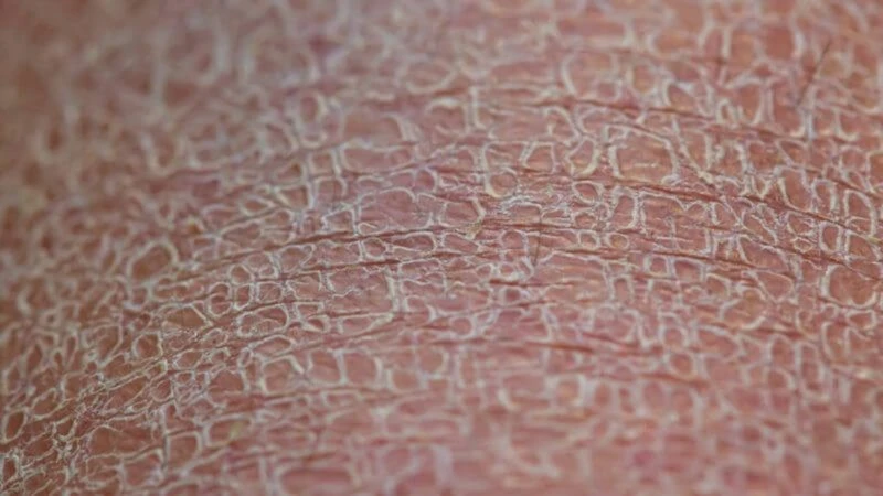 Da chân bị khô như da rắn khiến bề mặt sần sùi, bong vảy trắng, ngứa rát kéo dài